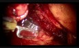 Retroperitoneal Partial Nephrectomy