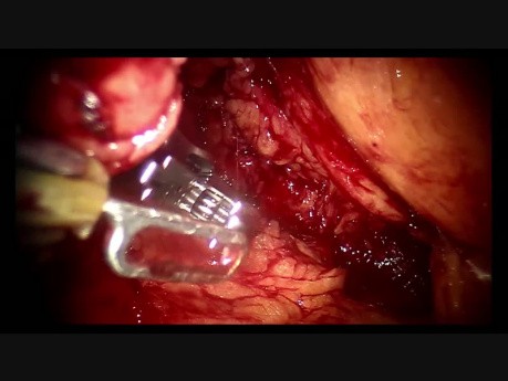 Retroperitoneal Partial Nephrectomy