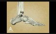 Charkot Foot - 3D Medical Animation