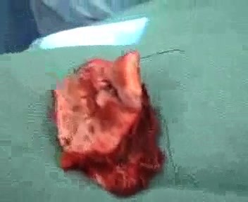 Cervicofacial Advancement Flap - Squamous Cell Carcinoma