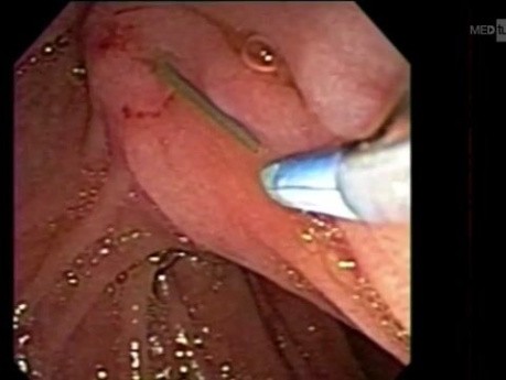 Laparoscopic cholecystectomy and intraoperative ERCP