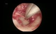 Endoscopic PORP Tympanoplasty for Chronic Mucosal Otitis Media