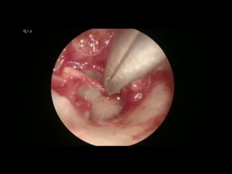Endoscopic PORP Tympanoplasty for Chronic Mucosal Otitis Media