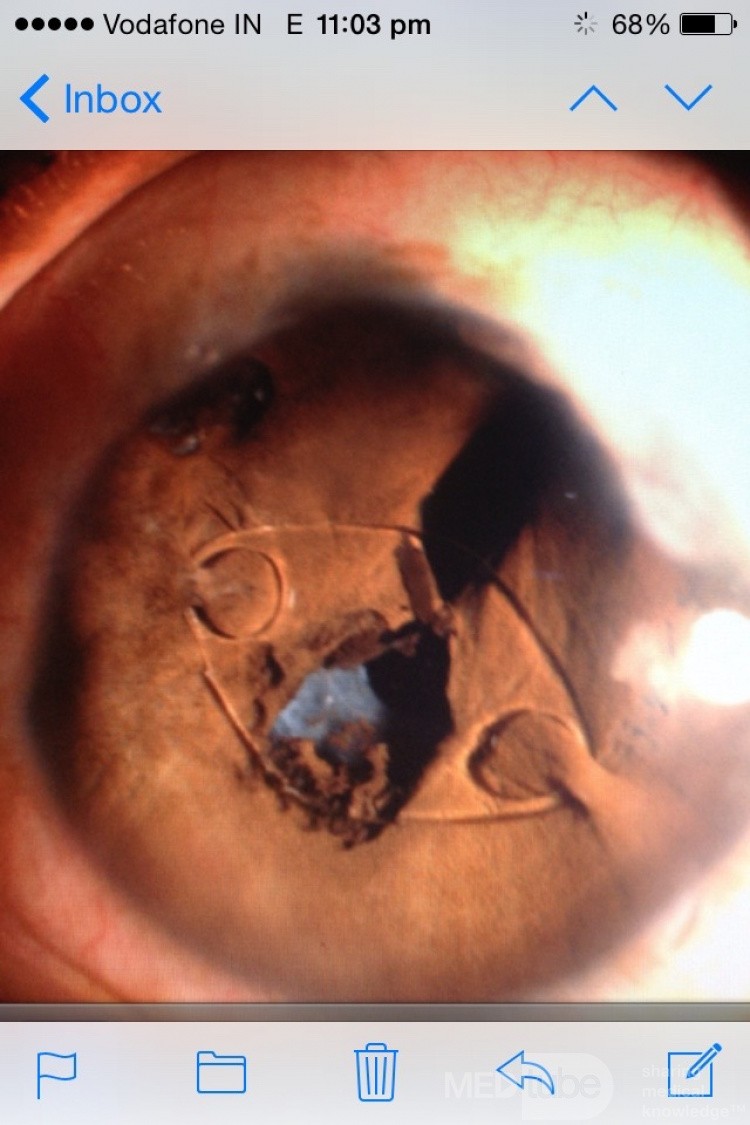 Secondary IOL in a Case of Complicated Aphakia
