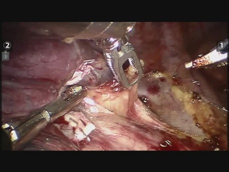 Robotic Surgery - Right Upper Lobectomy