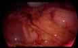 Diagnostic Laparoscopy with Biopsy...Abd TB