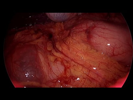 Diagnostic Laparoscopy with Biopsy...Abd TB