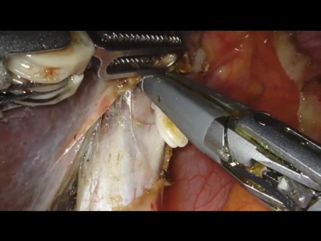 Robotic Resection of a Type IIIB Klatskin Tumor