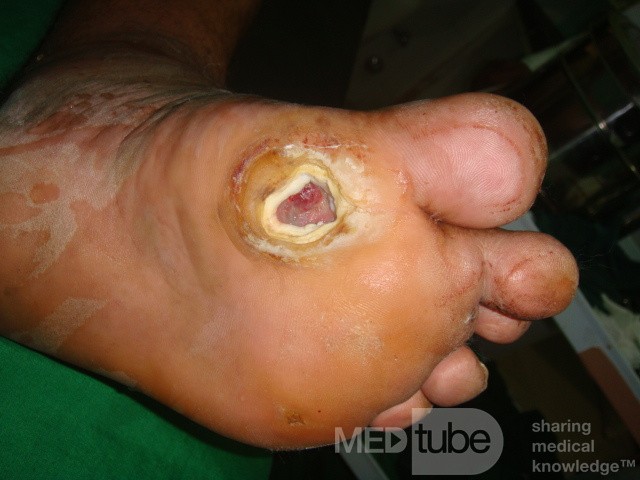 Diabetic foot ulcer - neuropathic -associated with ostemyelitis 