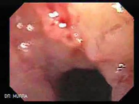 Esophageal Squamous Cell Carcinoma (2 of 2)