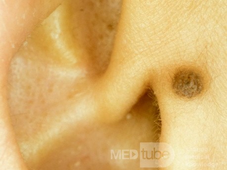 Compound Nevus