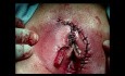 Vulva Cancer Exeresis And Double Flap