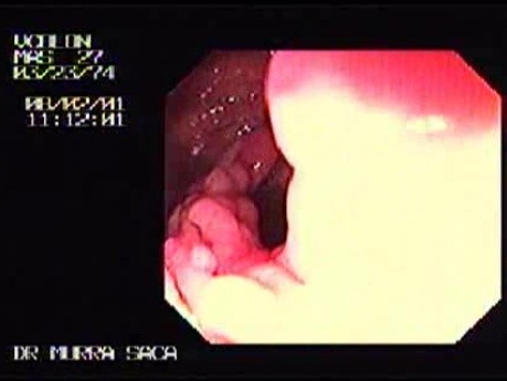 Familial Adenomatous Polyposis of the Colon (3 of 30)