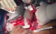 Ascending Aorta to Descending Aorta Bypass for Coarctation and Interupted Aortic Arch