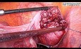 Laparoscopic Myomectomy for Intramural Fibroid using Baseball Suturing