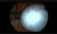 Laparoscopic Torsion Due to Ovarian & Paraovarian Cysts