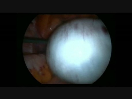 Laparoscopic Torsion Due to Ovarian & Paraovarian Cysts