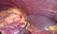  Laparoscopic Left Colectomy with Inferior Mesenteric Vessels Preservation for Splenic Flexure Cancer