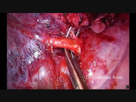 Single Port Revats to Lobectomy after Thoracotomy
