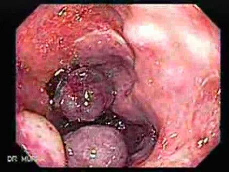 Long Standing Alcohol Abuse - Ligation of Nine Esophageal Varices