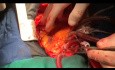Video Series of Post MI VSR Surgical Repair with New Exclusion Technique 