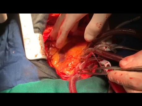 Video Series of Post MI VSR Surgical Repair with New Exclusion Technique 