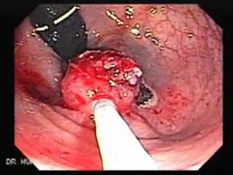 Endoscopic Resection of Giant Tubulo-Villous of the rectum (19 of 35)