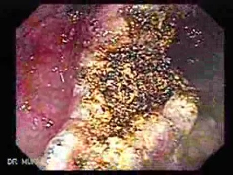 Multiple Adenomatous Polyps Of The Rectum (25 of 37)