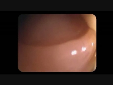 Colonoscopy Channel - Epinephrine Volume Reduction 1