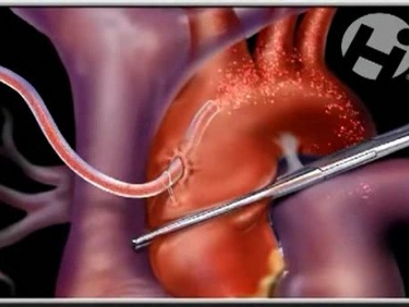 Ventricular Septal Defect