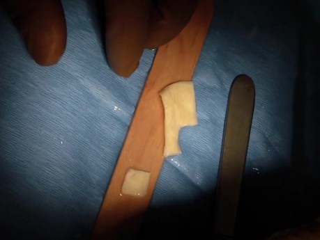 Part 3/8: Root Coverage Surgery - Mandibular Premolar - Slice'N'Dice Alloderm