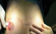 Repairing Pectus Carinatum in Children
