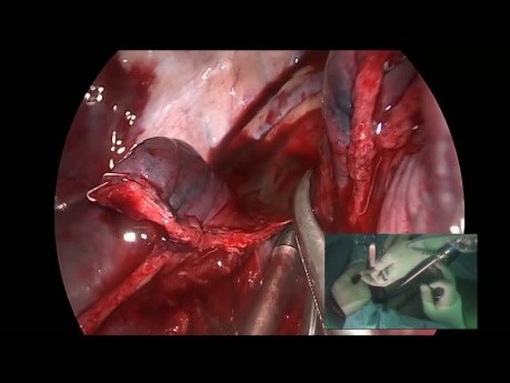 Bleeding Control by Uniportal VATS in a Complex Tumor with Abnormal Artery