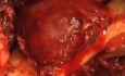 Mandibular Ameloblastoma - Resection And Recontruction