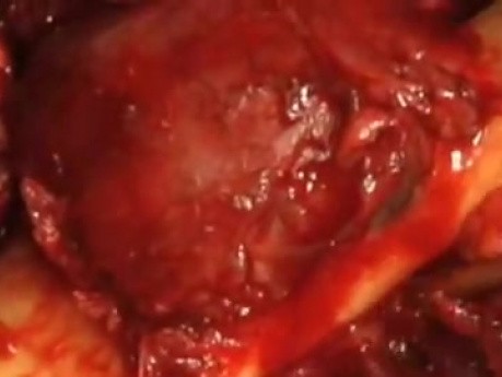 Mandibular Ameloblastoma - Resection And Recontruction