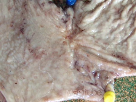 Small Gastric Adenocarcinoma of the Diffuse Ring Cell (11 of 19)