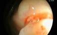 Ascending Colon Polyp Visible Only in Inverted Endoscope Position
