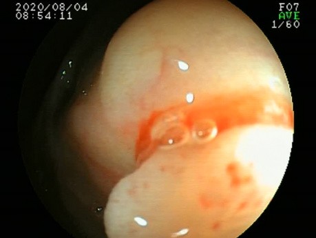 Ascending Colon Polyp Visible Only in Inverted Endoscope Position