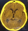 Endoscopic Third Ventriculostomy in a Benign Case of Aicardi Syndrome with Obstructive Hydrocephalus and Chiari Malformation type 1