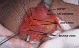 Fluorescence Angiography using Indocyanine Green in Subinguinal Varicocelectomy