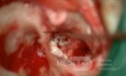 Epitympanic Cholesteatoma