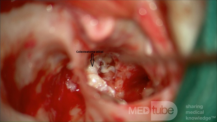 Epitympanic Cholesteatoma
