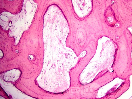 Osteoma of the External Canal [histology]