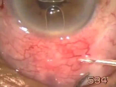 Tenon's Cyst - Management