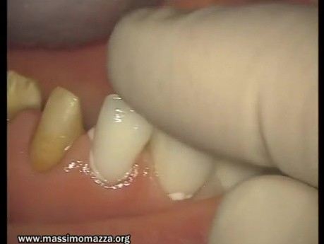Glass Ionomer Cementation (2/6)