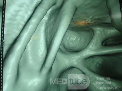 Adenocarcinoma of the Transverse Colon (8 of 15)