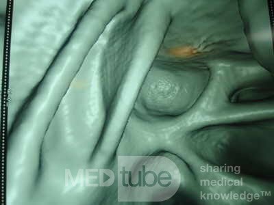 Adenocarcinoma of the Transverse Colon (8 of 15)