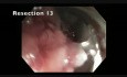 Rectosigmoid Colon Polyp - Giant Polyp Resection