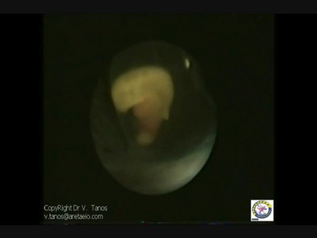 Embryoscopy