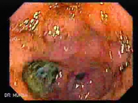 Multiple Gastric Ulcers - Endoscopy (9 of 10)